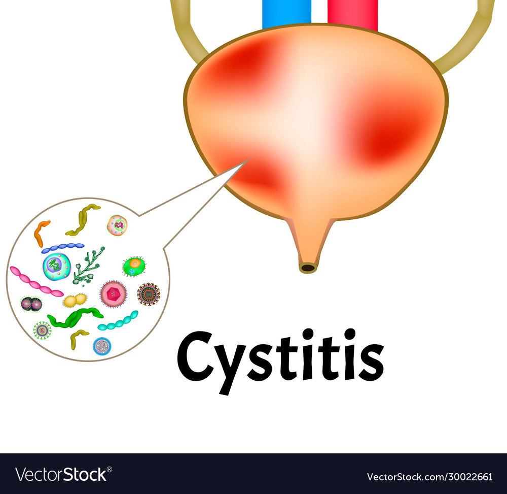 Cystitis Inflammation Bladder Royalty Free Vector Image