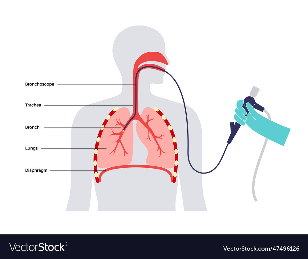 Bronchoscopy Procedure Concept Royalty Free Vector Image