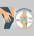 Osteoarthritis Knee Poster Royalty Free Vector Image