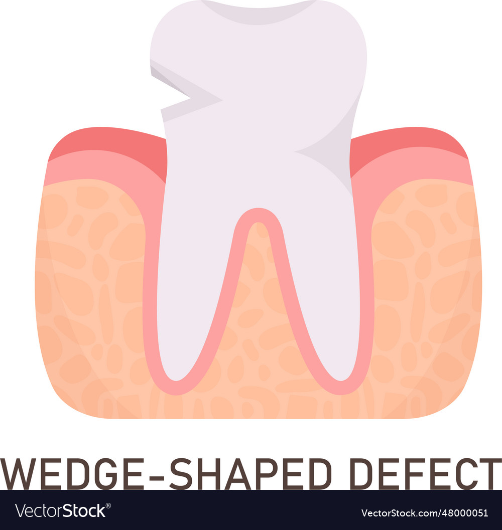 Wedgeshaped defect tooth problem Royalty Free Vector Image