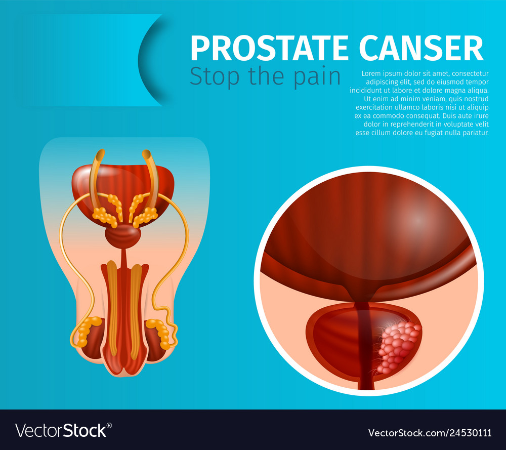 dolor de cáncer de próstata ancardi dolor de cáncer de próstata ancardi