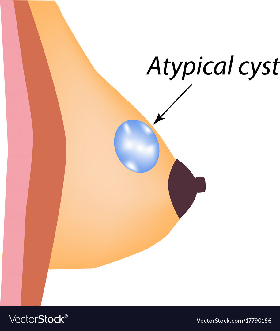 Breast lumps and cysts