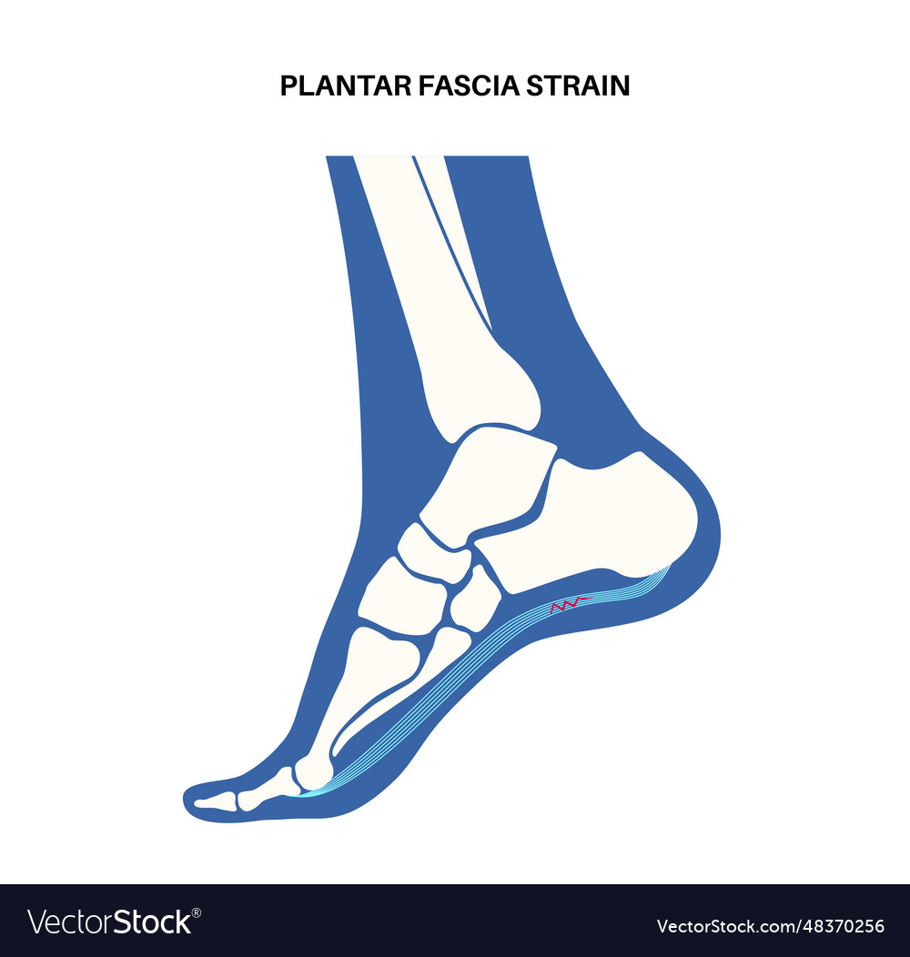 Plantar fascia strain Royalty Free Vector Image