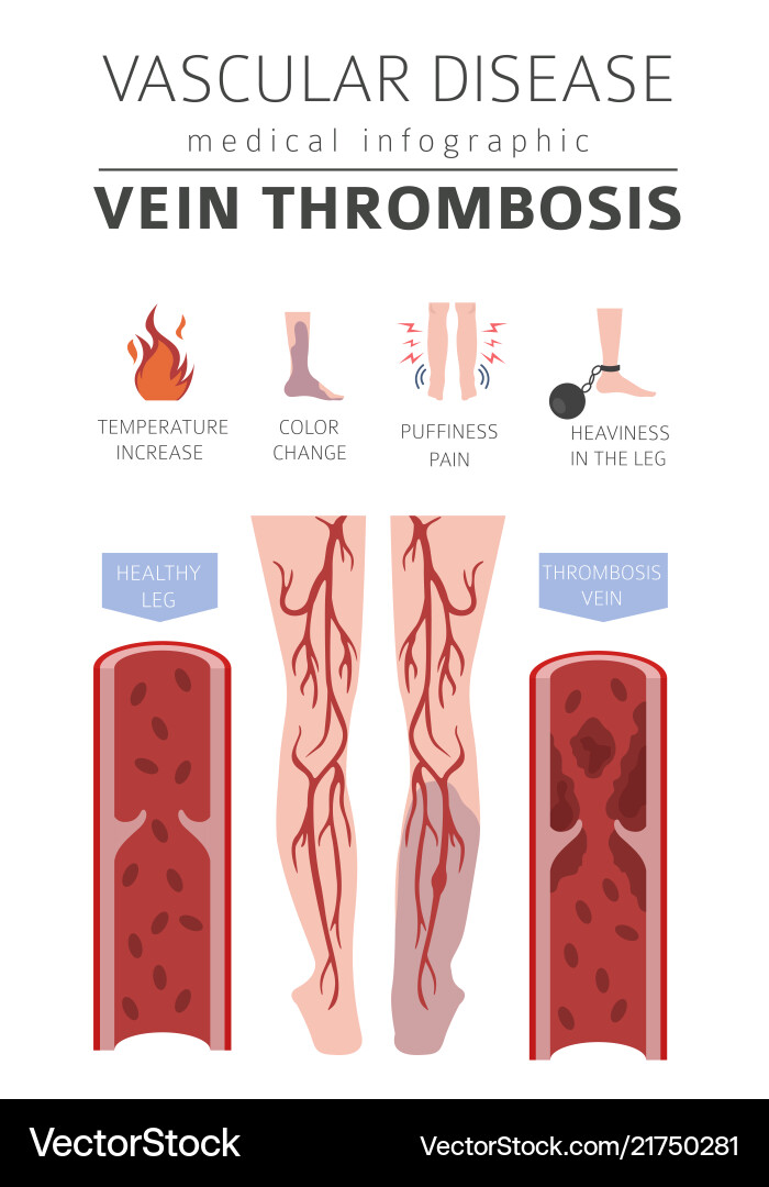 Vascular diseases vein thrombosis symptoms Vector Image