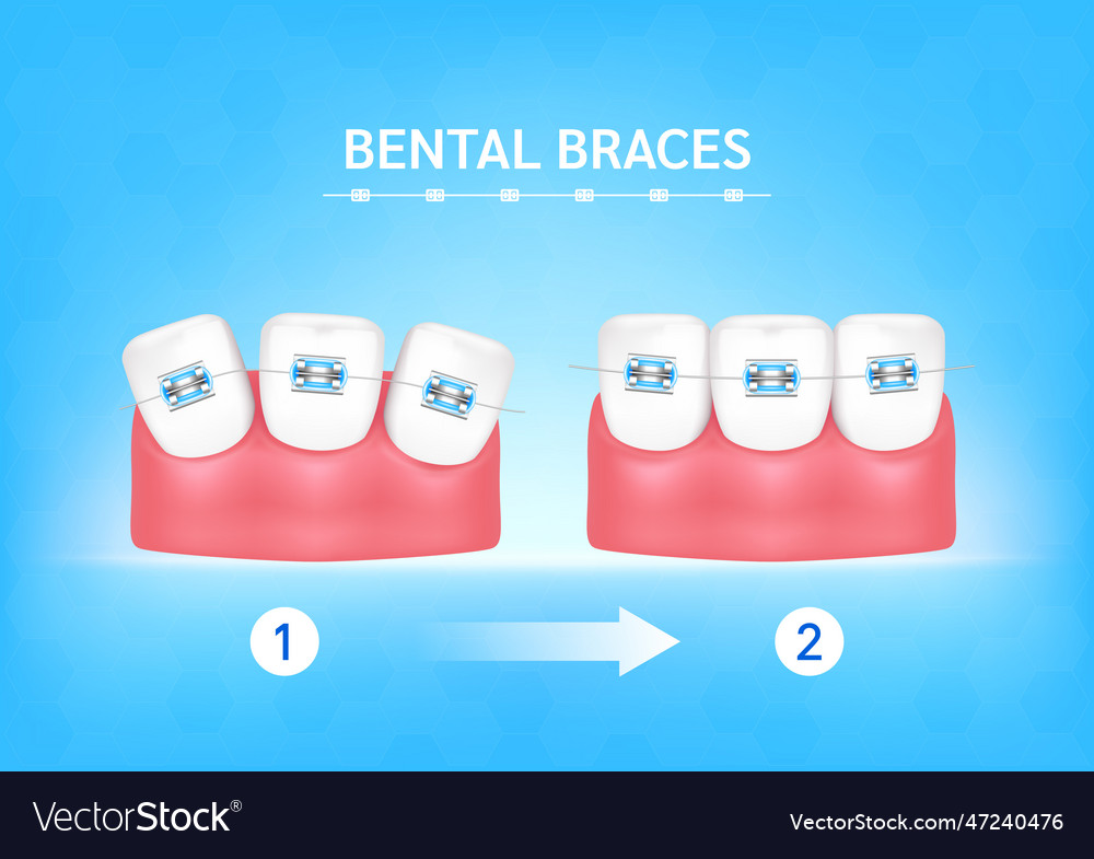 Orthodontic treatment style fashion Royalty Free Vector