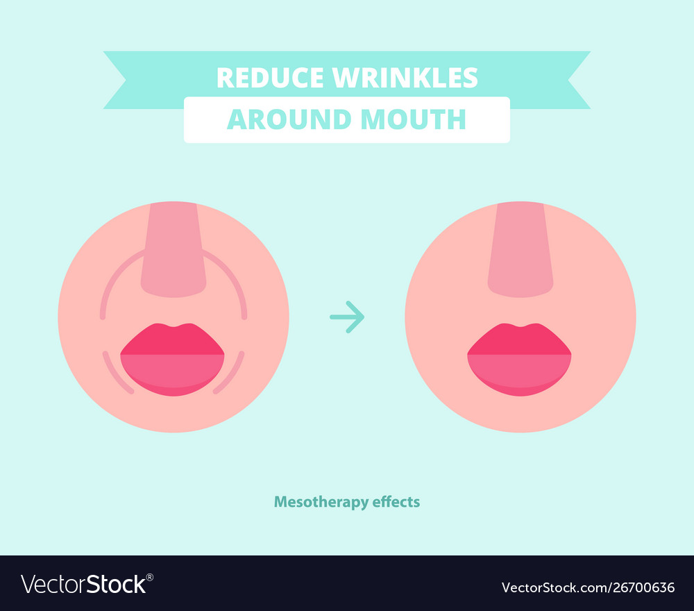 Reducing wrinkles after mesotherapy Royalty Free Vector