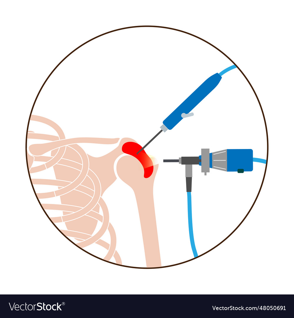 Shoulder Arthroscopy Poster Royalty Free Vector Image