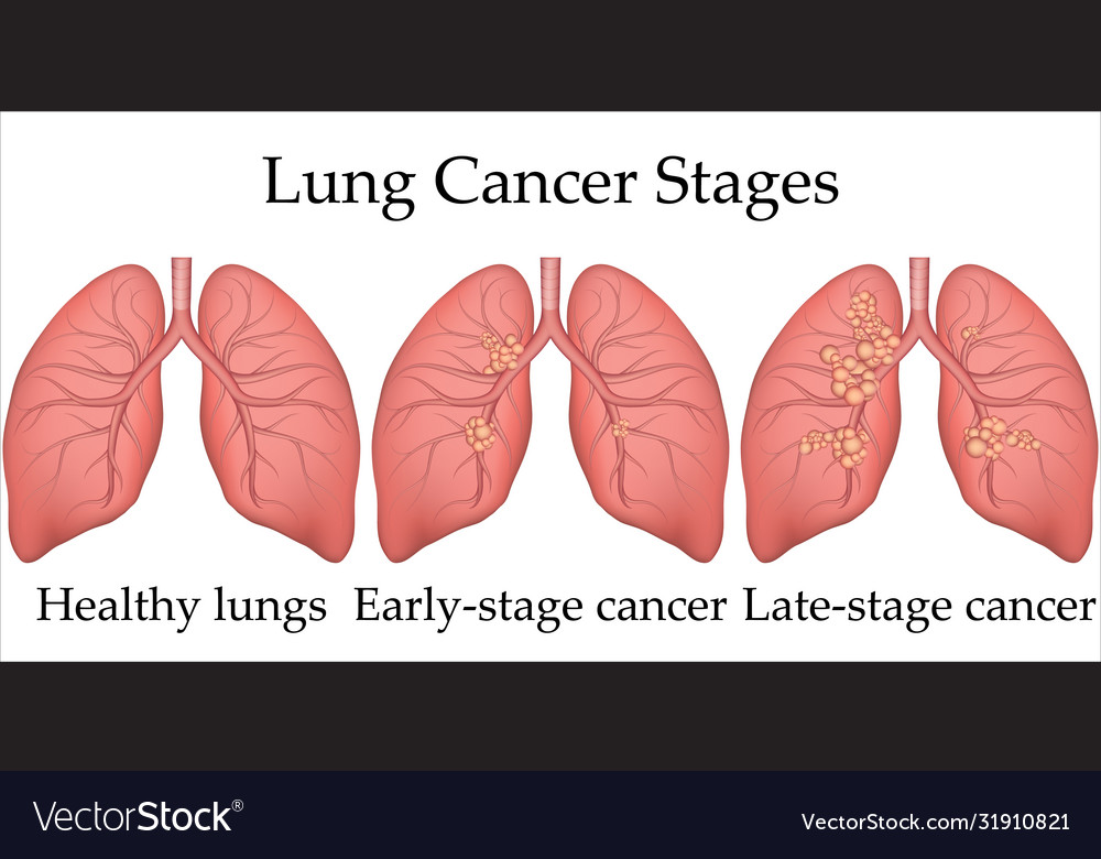 Medical human lung cancer Royalty Free Vector Image