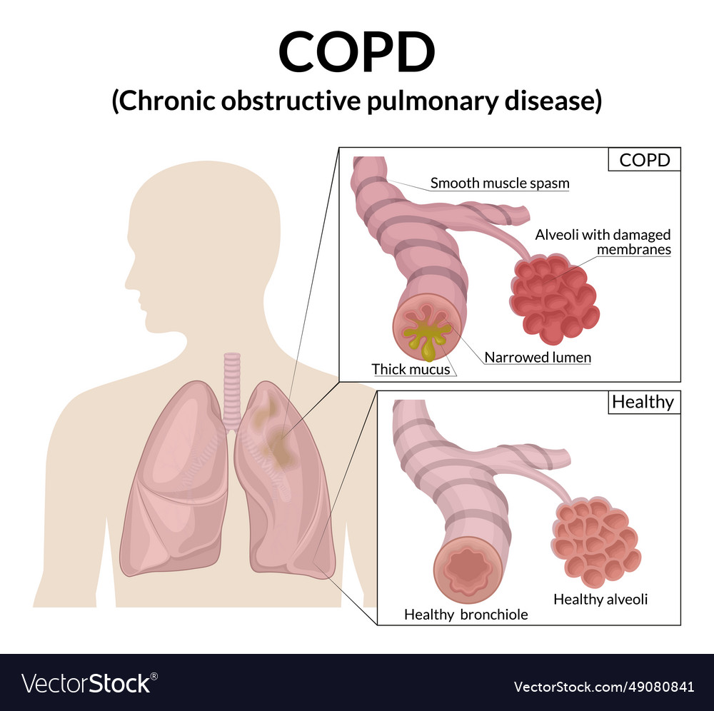 Chronic obstructive pulmonary disease Royalty Free Vector