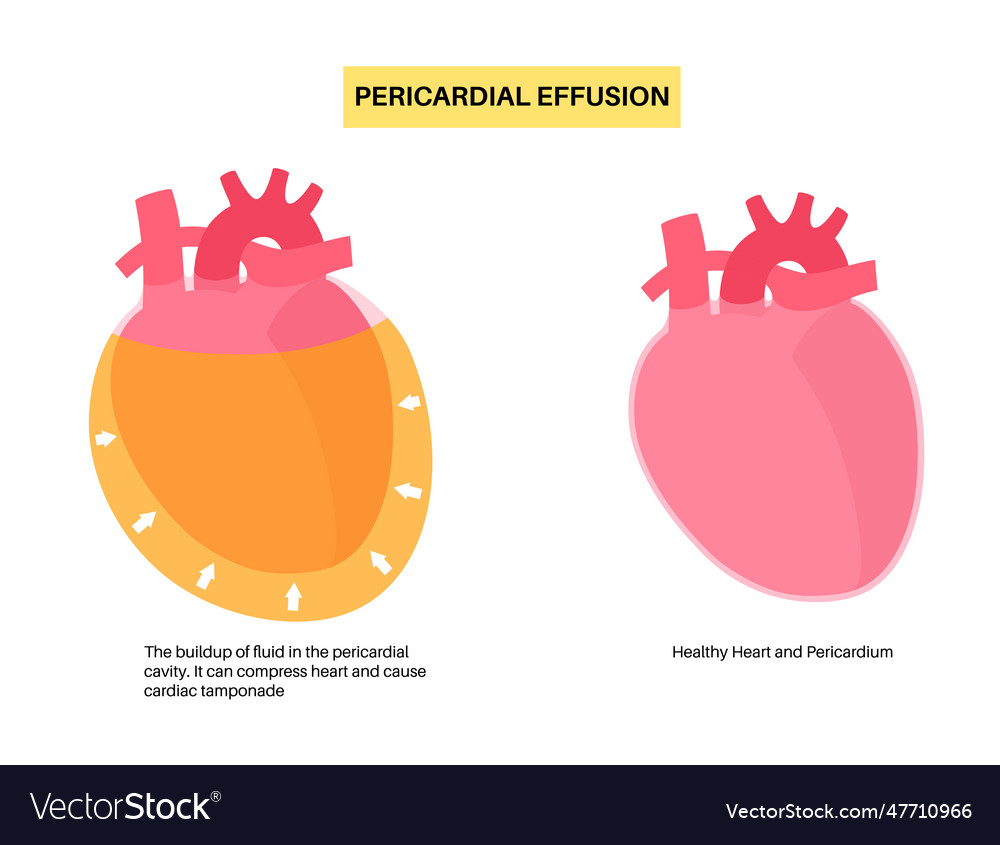 Pericardial effusion heart Royalty Free Vector Image