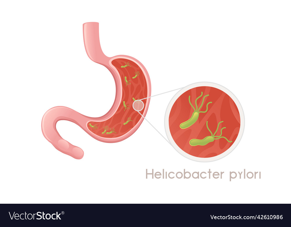 Human Stomach With Helicobacter Pylori Cartoon Vector Image