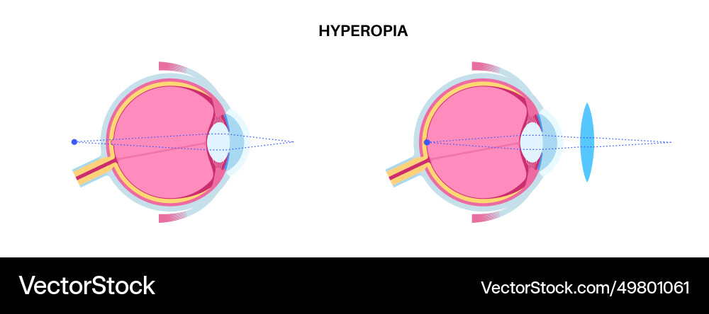 Normal eye and farsightedness Royalty Free Vector Image