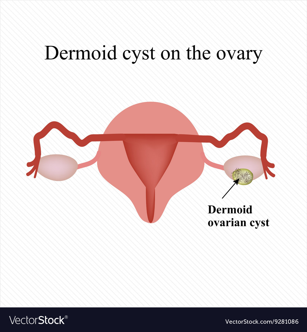 Dermoid cyst on the ovary infographics Royalty Free Vector