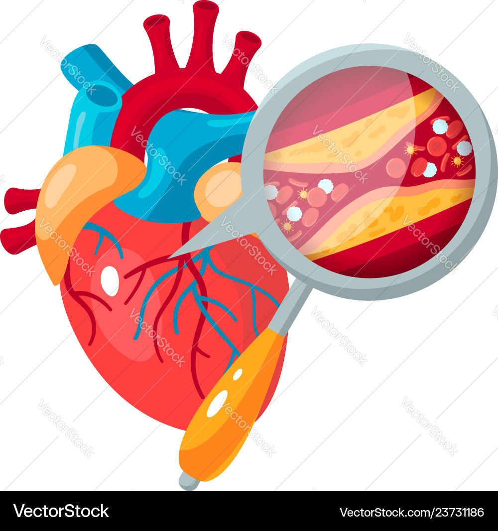 Coronary Artery Disease Concept In Flat Style Vector Image