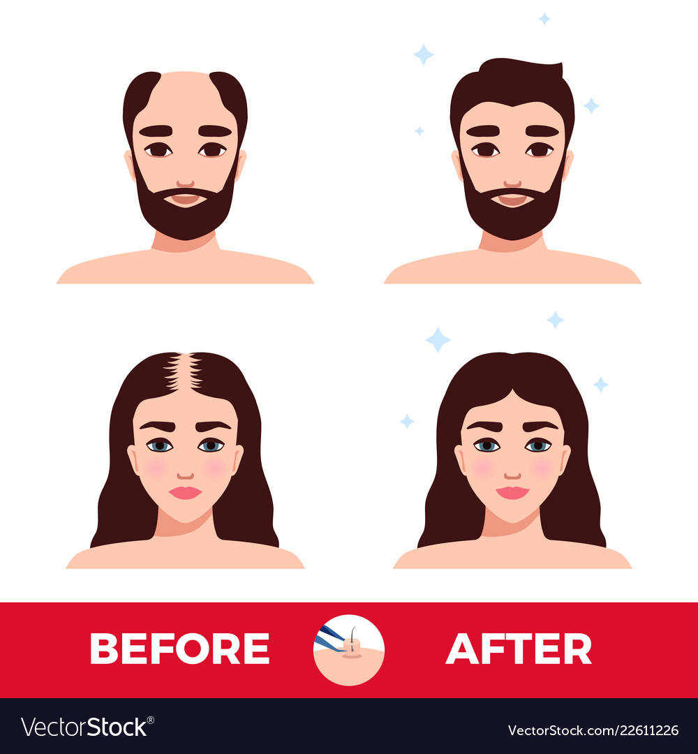 Hair Transplantation Before And After Royalty Free Vector