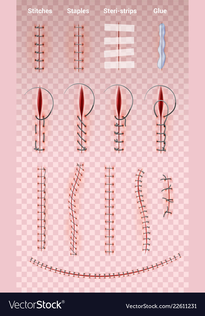 surgical suture