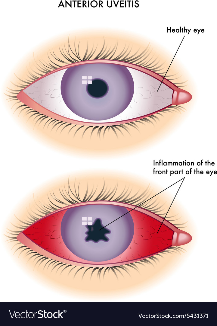 Uveitis Royalty Free Vector Image - VectorStock