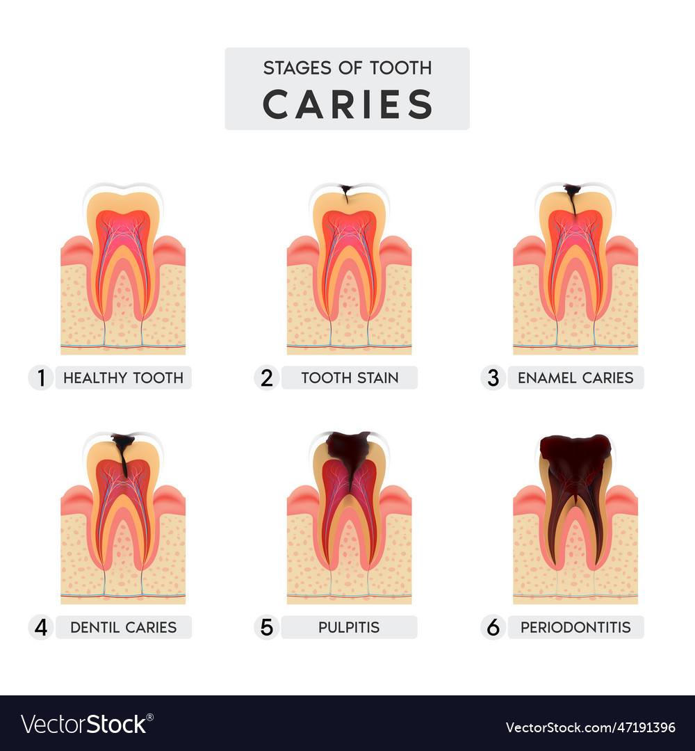 Tooth caries structure and progression Royalty Free Vector