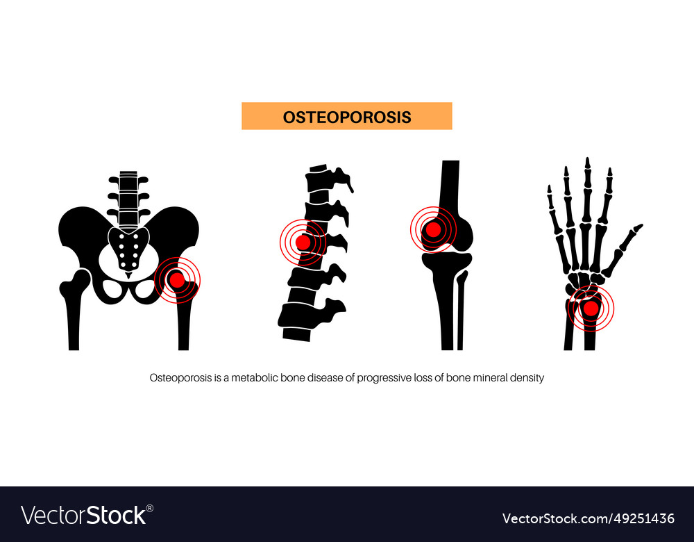 Osteoporosis Medical Poster Royalty Free Vector Image