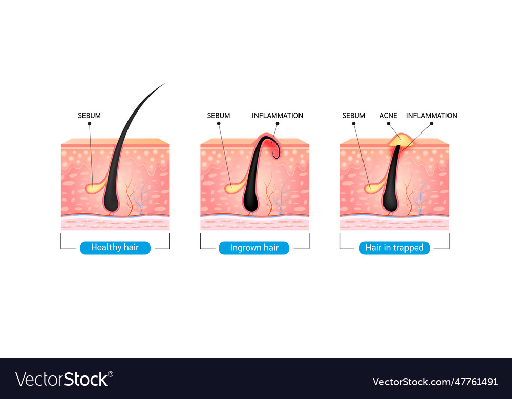 Ingrown hair Royalty Free Vector Image - VectorStock