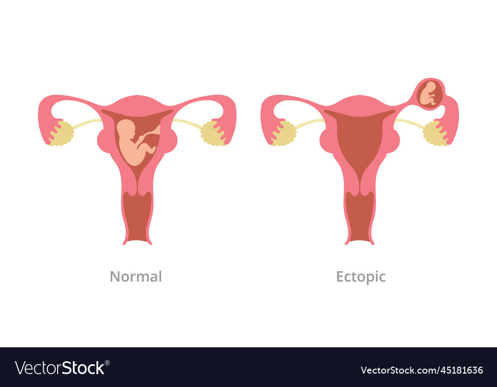 Ectopic pregnancy problem Royalty Free Vector Image