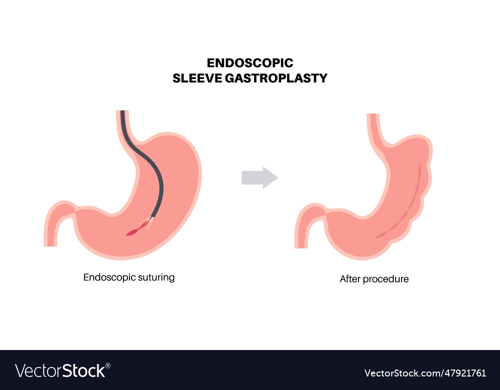 Endoscopic sleeve gastroplasty Royalty Free Vector Image