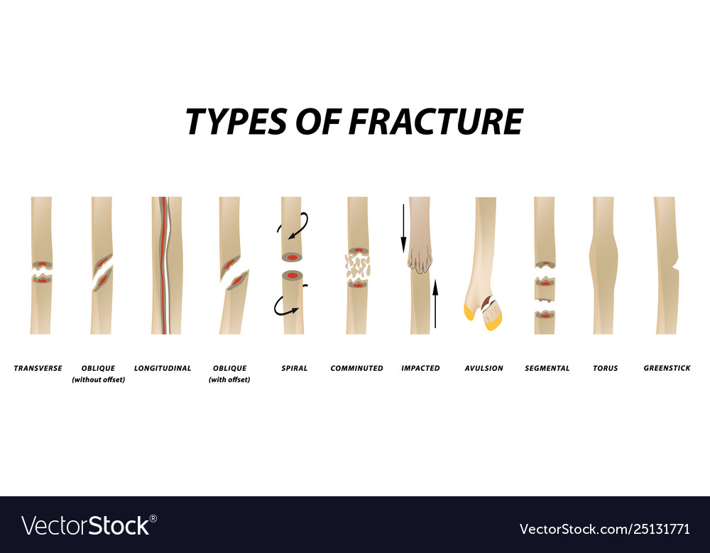 Types fracture fracture bone set infographics Vector Image