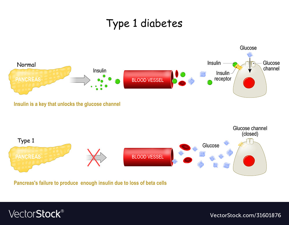 Types 1 Diabetes Mellitus Royalty Free Vector Image