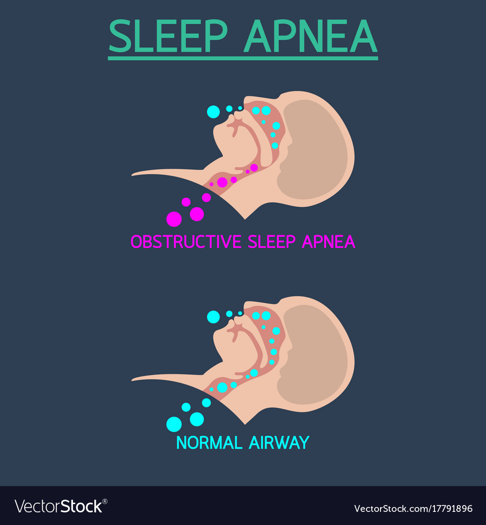 Sleep apnea icon Royalty Free Vector Image - VectorStock