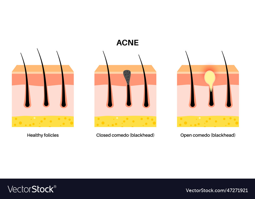 Acne Treatment Poster Royalty Free Vector Image