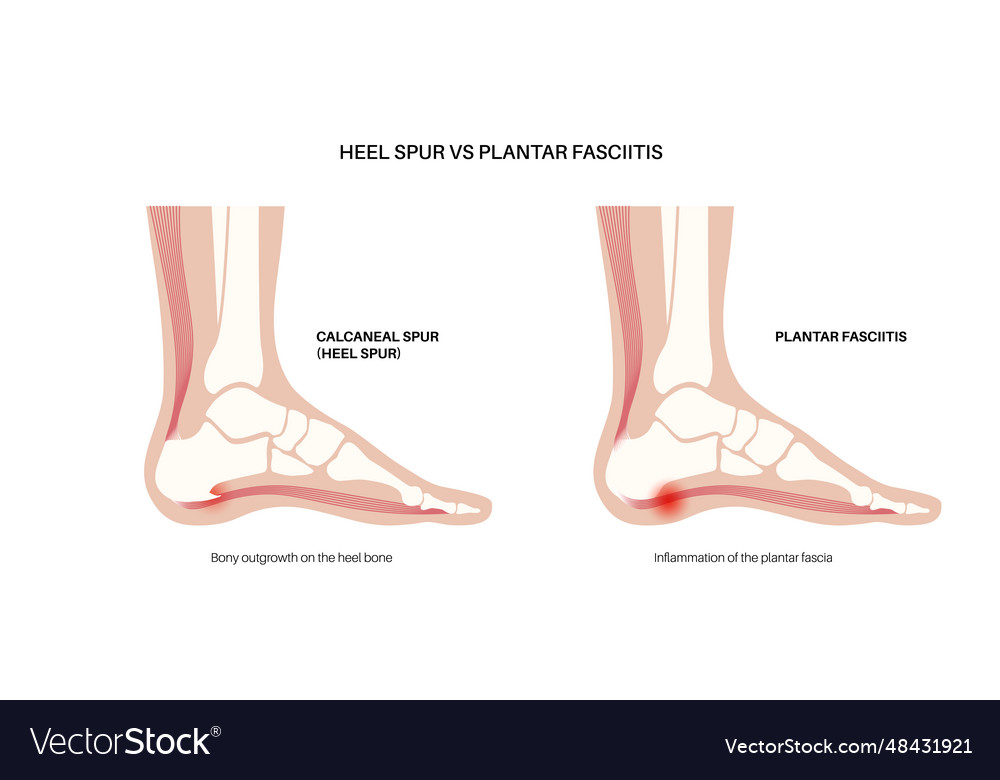 Heel spur and plantar fasciitis Royalty Free Vector Image