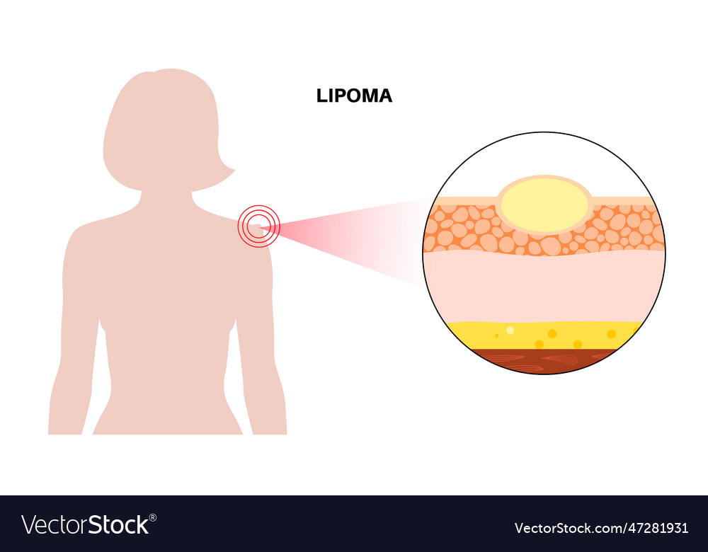 Lipoma Medical Poster Royalty Free Vector Image