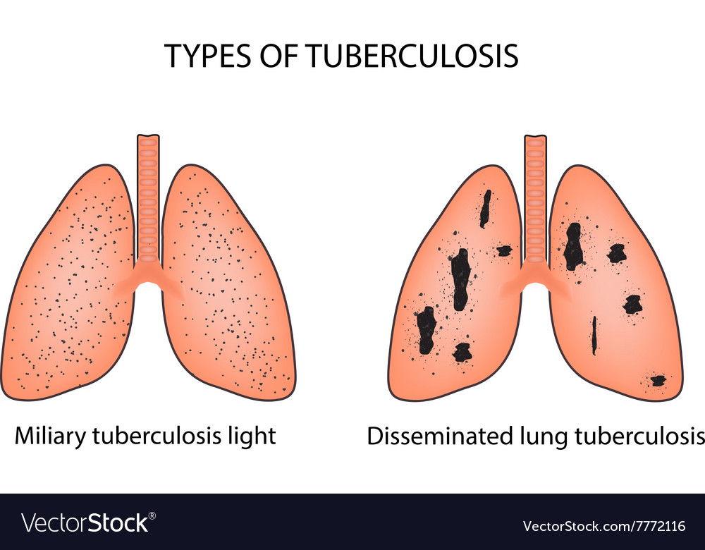 Types of tuberculosis military and disseminated Vector Image