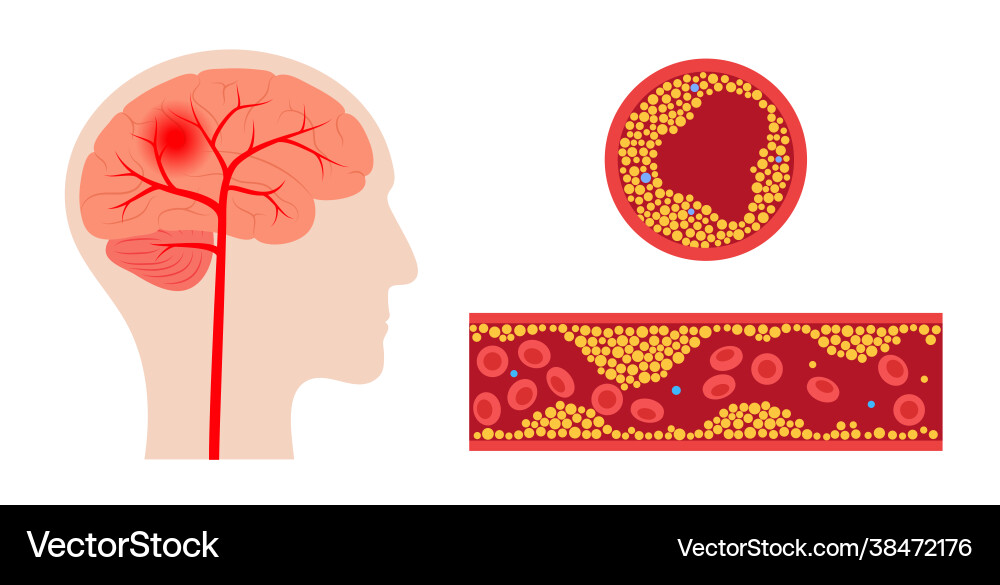 Brain stroke ishemic Royalty Free Vector Image