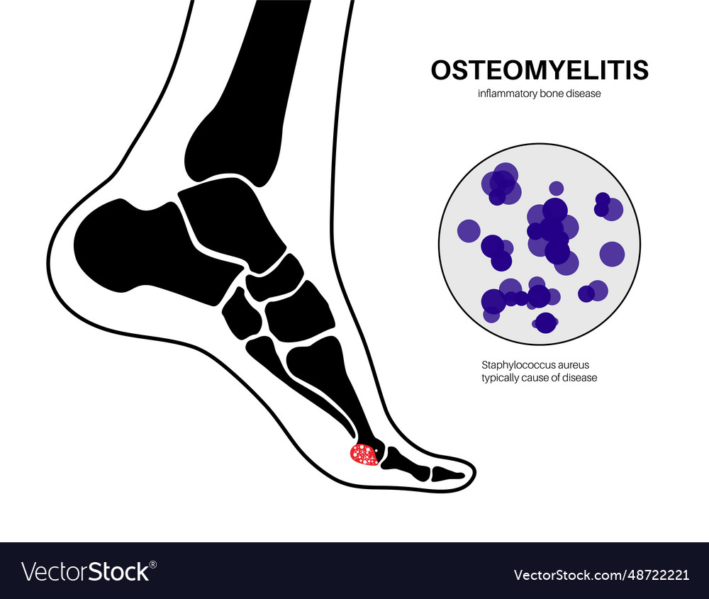 Osteomyelitis of feet Royalty Free Vector Image