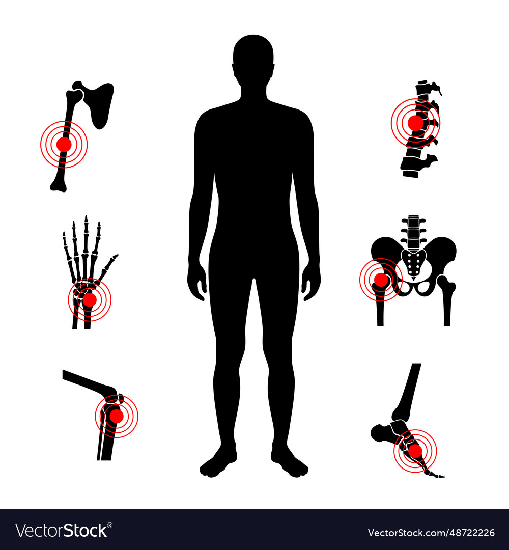 Osteomyelitis disease poster Royalty Free Vector Image