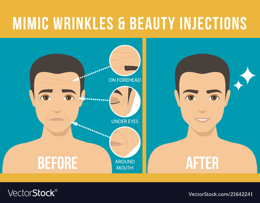 Cosmetic procedures botox Royalty Free Vector Image