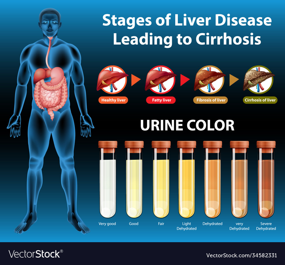 Stages liver disease leading to cirrhosis Vector Image