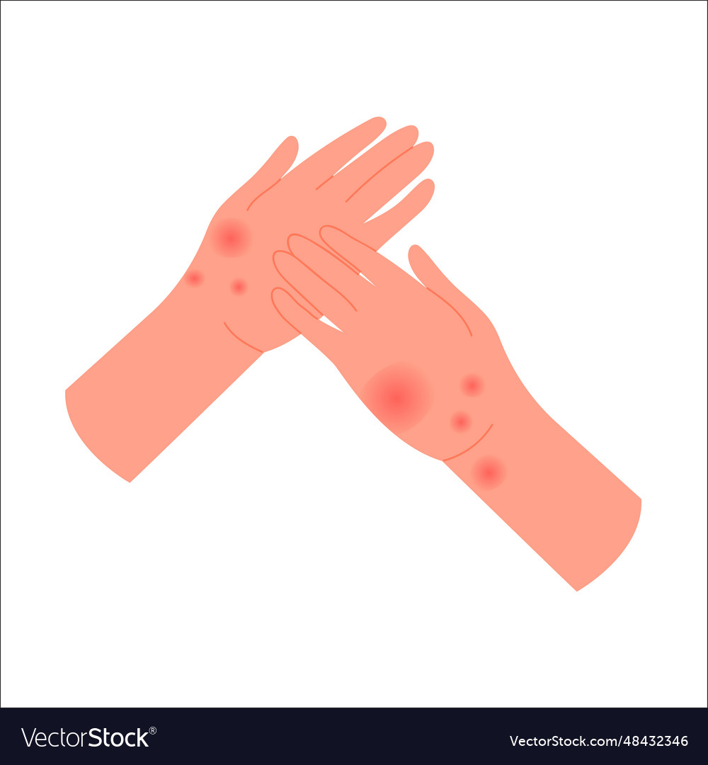 how to get rid of an allergic reaction on your hands