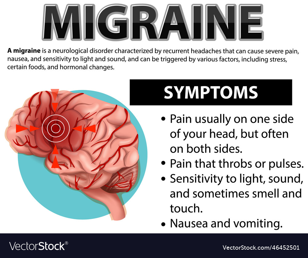 Informative Poster Of Migraine Royalty Free Vector Image