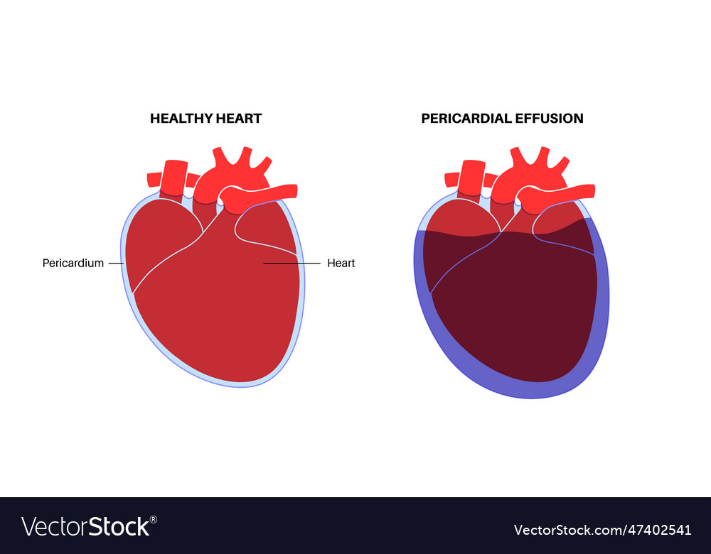 Pericardial Effusion Heart Royalty Free Vector Image