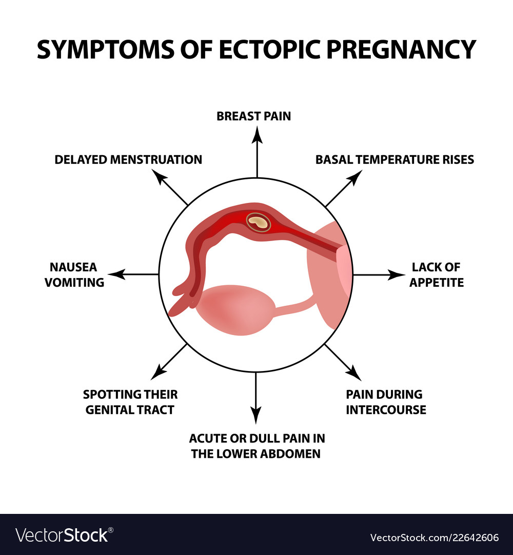 Symptoms Ectopic Pregnancy Infographics Royalty Free Vector 