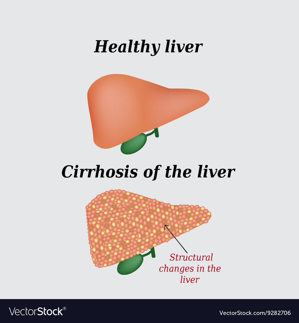 Cirrhosis of the liver