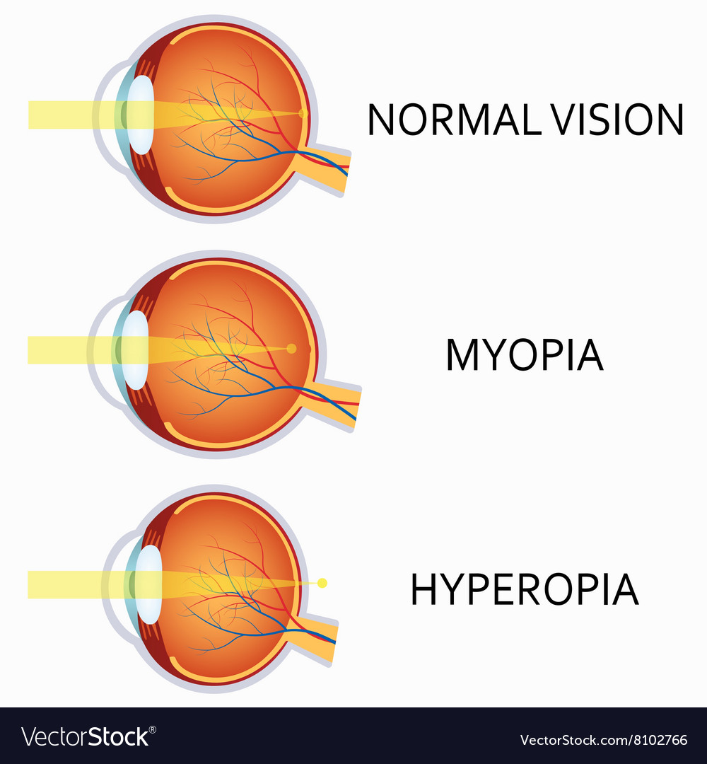 Optical Human Eye Defects Myopia And Hyperopia Vector Image