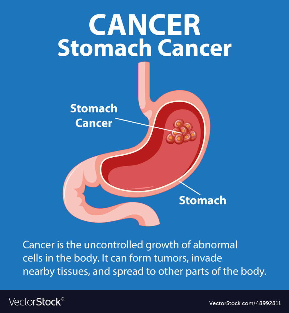 Infographic of stomach cancer growth Royalty Free Vector