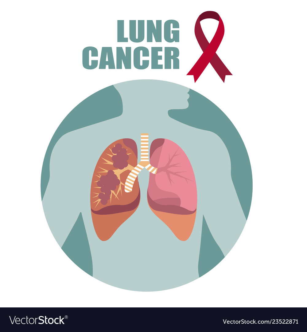 Human lungs are affected cancer health Royalty Free Vector