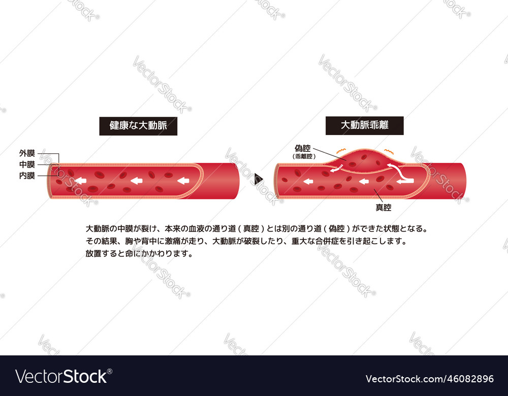 Comparison of normal aorta and aortic dissection