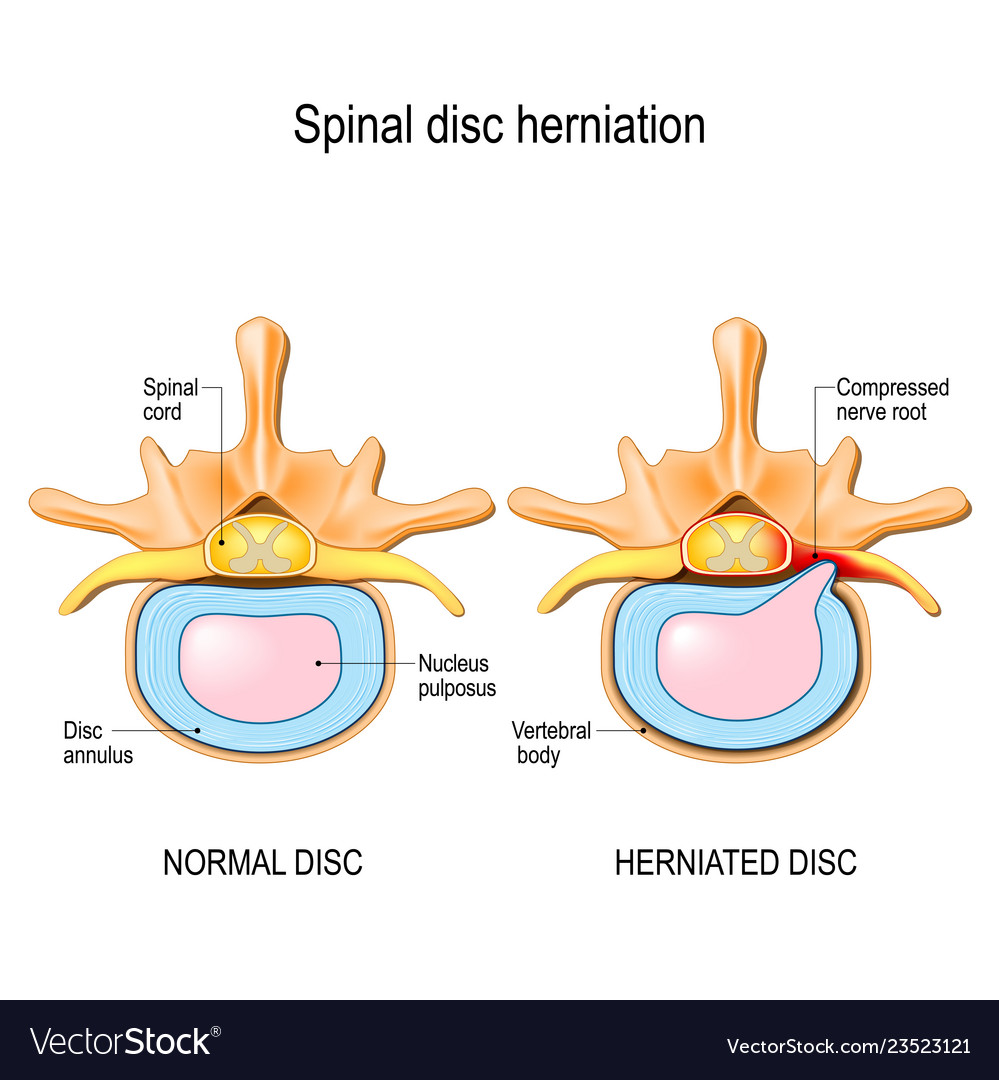 Normal disc and spinal disc herniation Royalty Free Vector