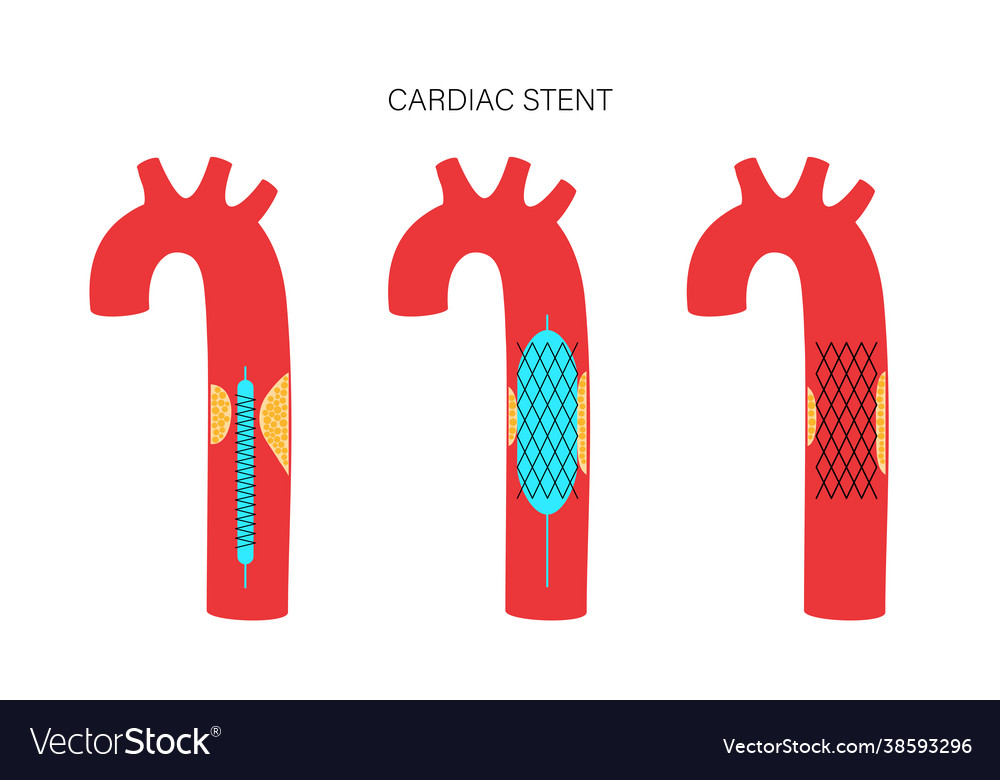 Angioplasty cardiac stent Royalty Free Vector Image