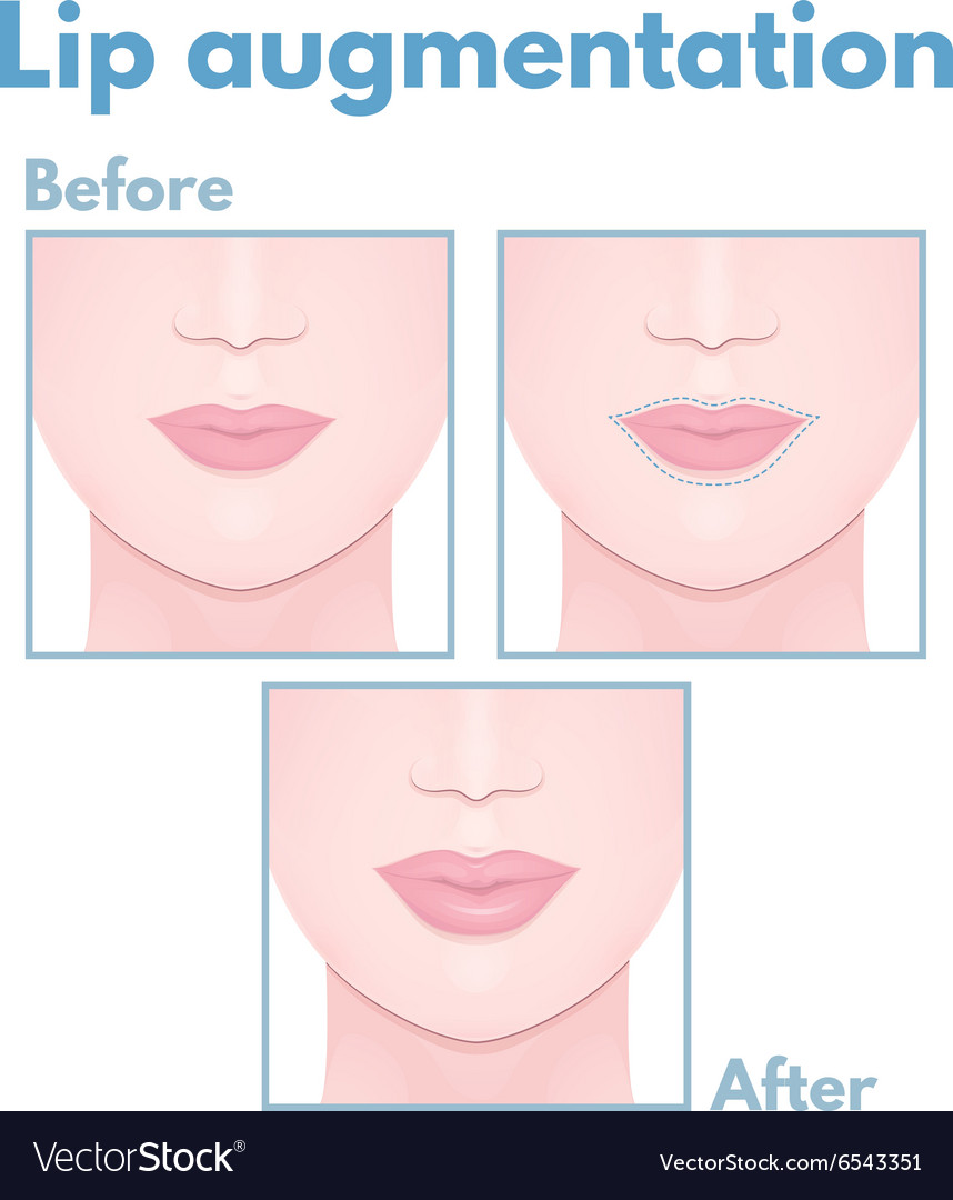 Plastic surgery lip Royalty Free Vector Image - VectorStock